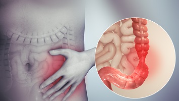 Irritable Bowel Syndrome Treatment
